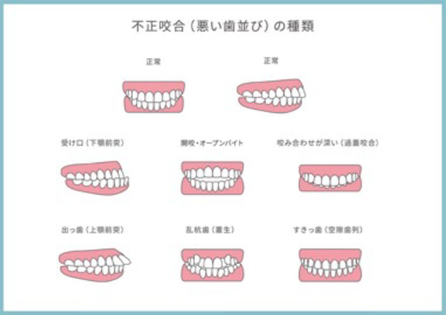 不正咬合の種類