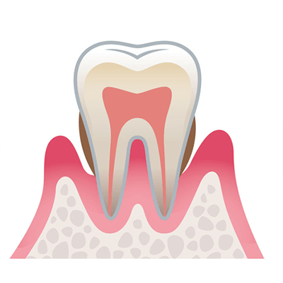 中度歯周病