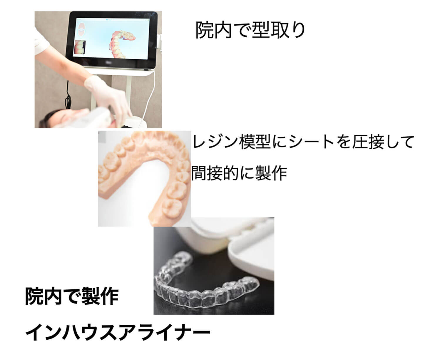 院内で製造する熱可塑性アライナー