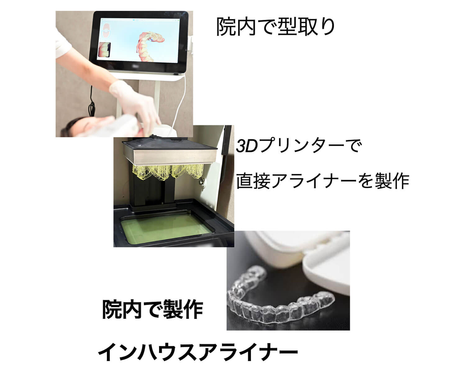 院内で製造する形状記憶アライナー